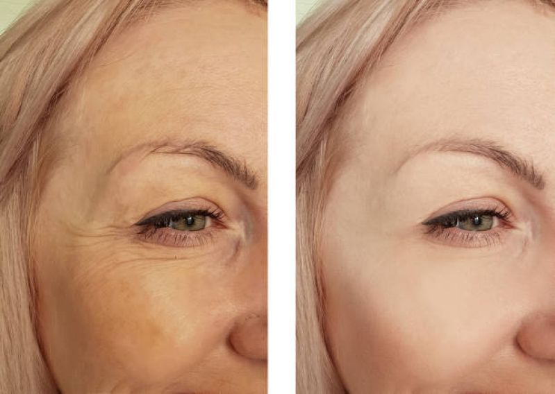 Antes e Depois - Reduz linhas finas